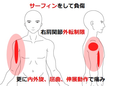 施術報告 肩痛】施術例4 スポーツ(サーフィン)により痛めた肩部痛