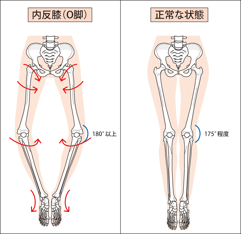 船堀でO脚(内反膝)でお悩みの方へ］ - 江戸川区船堀 はればれ鍼灸整骨院
