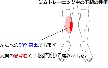 【症例報告 ふくらはぎの肉離れ】施術例12 ジムトレーニング中の下腿の挫傷 - 江戸川区船堀 はればれ鍼灸整骨院