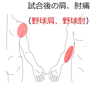 施術報告 肩痛】施術例15 投球数が多くなり出た肩、肘の痛み（野球肩